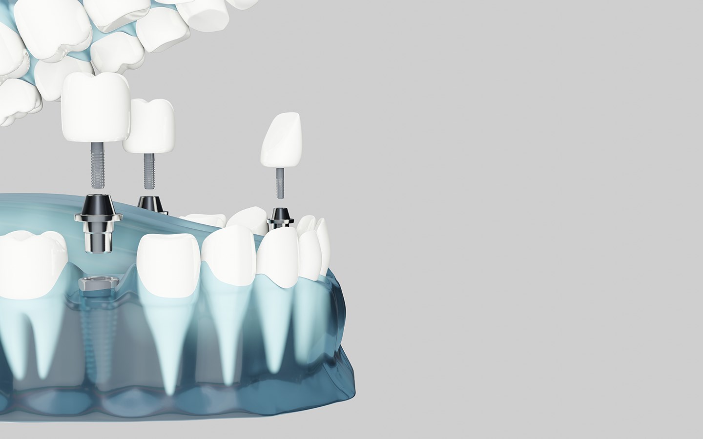 Dental İmplant ve Protez